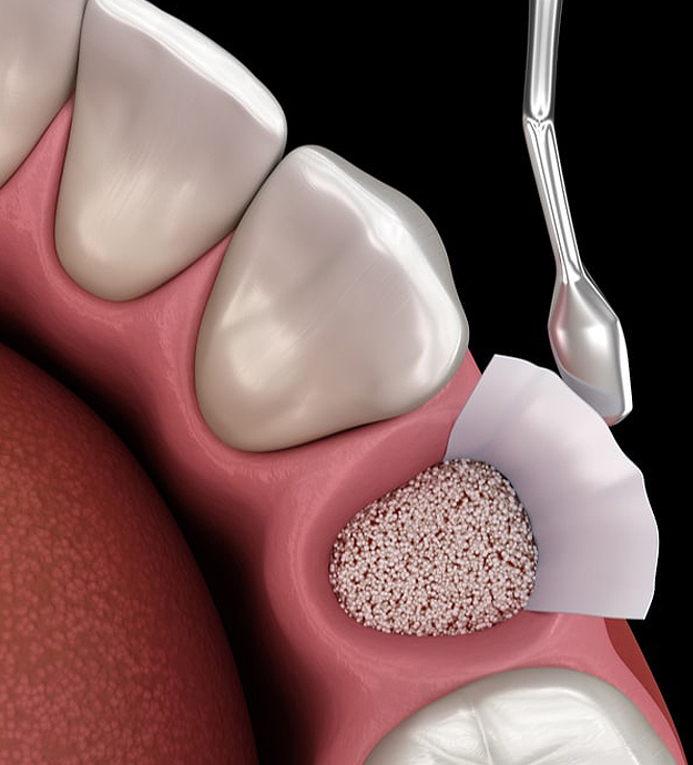 Dental Implants In Jupiter FL