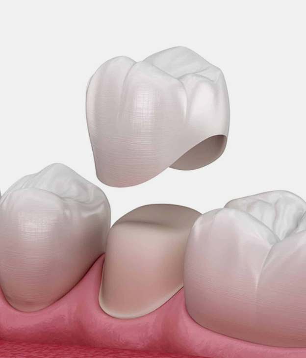 Dental Crowns In Jupiter FL