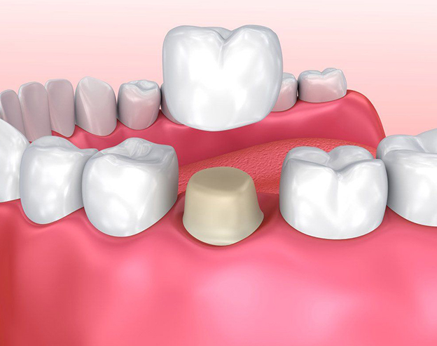 Dental crowns