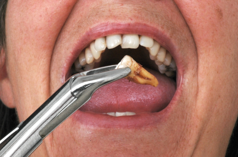 What You Shouldn't Eat Or Drink After Tooth Extraction
